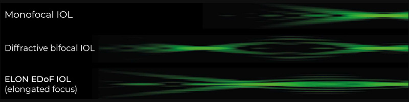 Wavefront Linking Technology from Medicontur